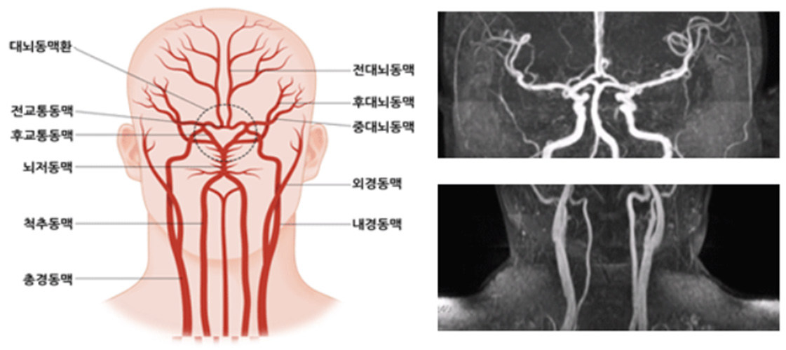 대뇌동맥환, 전교통동맥, 후교통동맥, 뇌저동맥, 척추동맥, 총경동맥, 전대뇌동맥, 후대뇌동맥, 중대뇌동맥, 외경동맥, 내경동맥