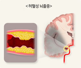 허혈성 뇌졸중