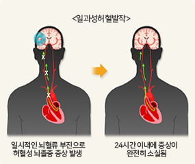 일과성 허혈발작, 일시적인 뇌혈류 부진으로 허혈성 뇌졸중 증상 발생, 24시간 이내애 증상이 완전히 소실됨